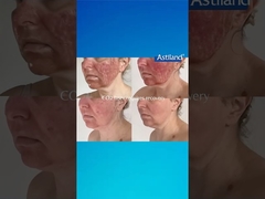 HIFU или Fractional CO2 Laser, какой вам больше нравится?