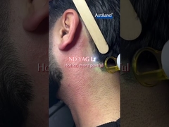 Диодный лазер против ND YAG лазера, какой ты предпочитаешь?