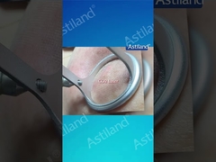 HIFU против CO2 лазера, какое лечение против старения вы предпочитаете?